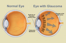 Birth Control Pill Use May Double Women’s Glaucoma Risk
