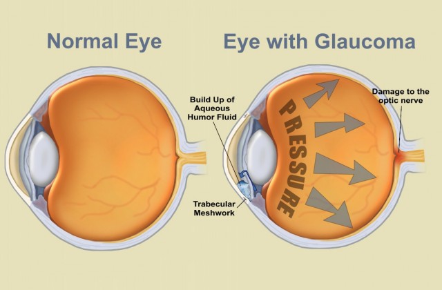 Birth Control Pill Use May Double Women's Glaucoma Risk, Source: http://www.oregoneyecenter.com/images/eyes_glaucoma.jpg