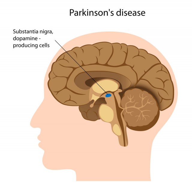 Study: Inhaled Cannabis Mitigates Parkinson’s Disease Symptoms, parkinson's disease - cannabis helps mitigate tel aviv study, Source: http://www.parkinsoninfo.org/about-parkinsons-disease/what-causes-parkinsons/