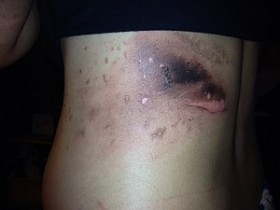 Prohibition Must Stop: Botched Drug Raid Literally Burns 12-Year-Old Girl