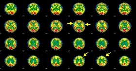 Study: Cannabidiol Holds Promise For Treating Psychosis