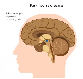 Study: Inhaled Cannabis Mitigates Parkinson’s Disease Symptoms