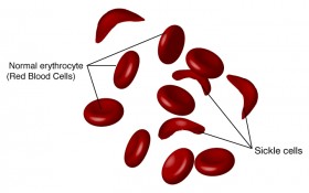 Study Says Medical Marijuana May Help Alleviate Pain in Sickle Cell Patients